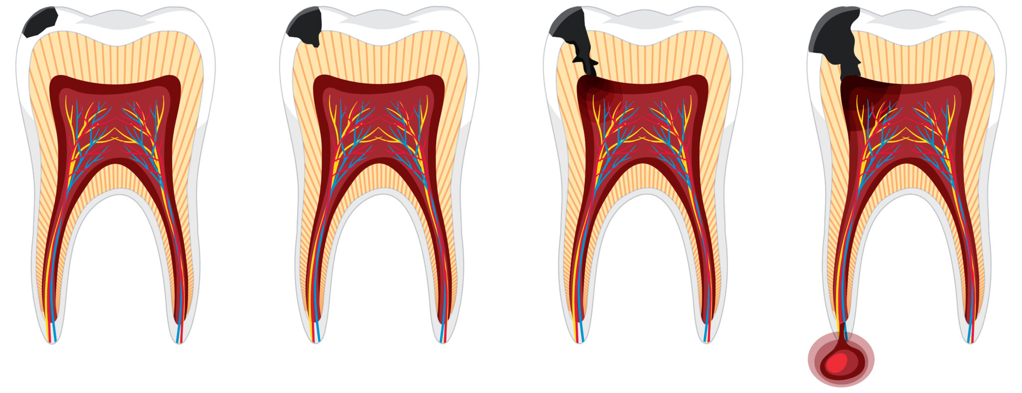 Root Canal Endodontics Dentist in Salt Lake City, UT Platinum Dental