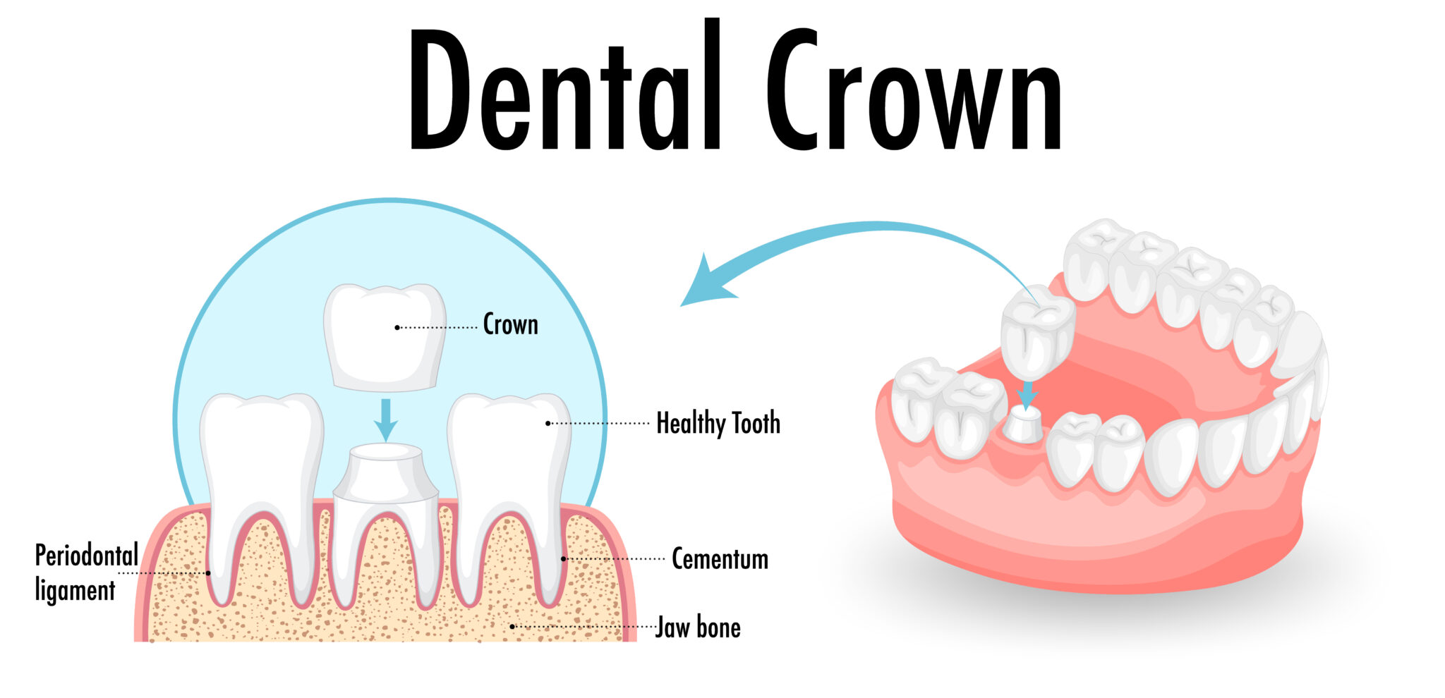 Crowns Dentist in Salt Lake City, UT Platinum Dental
