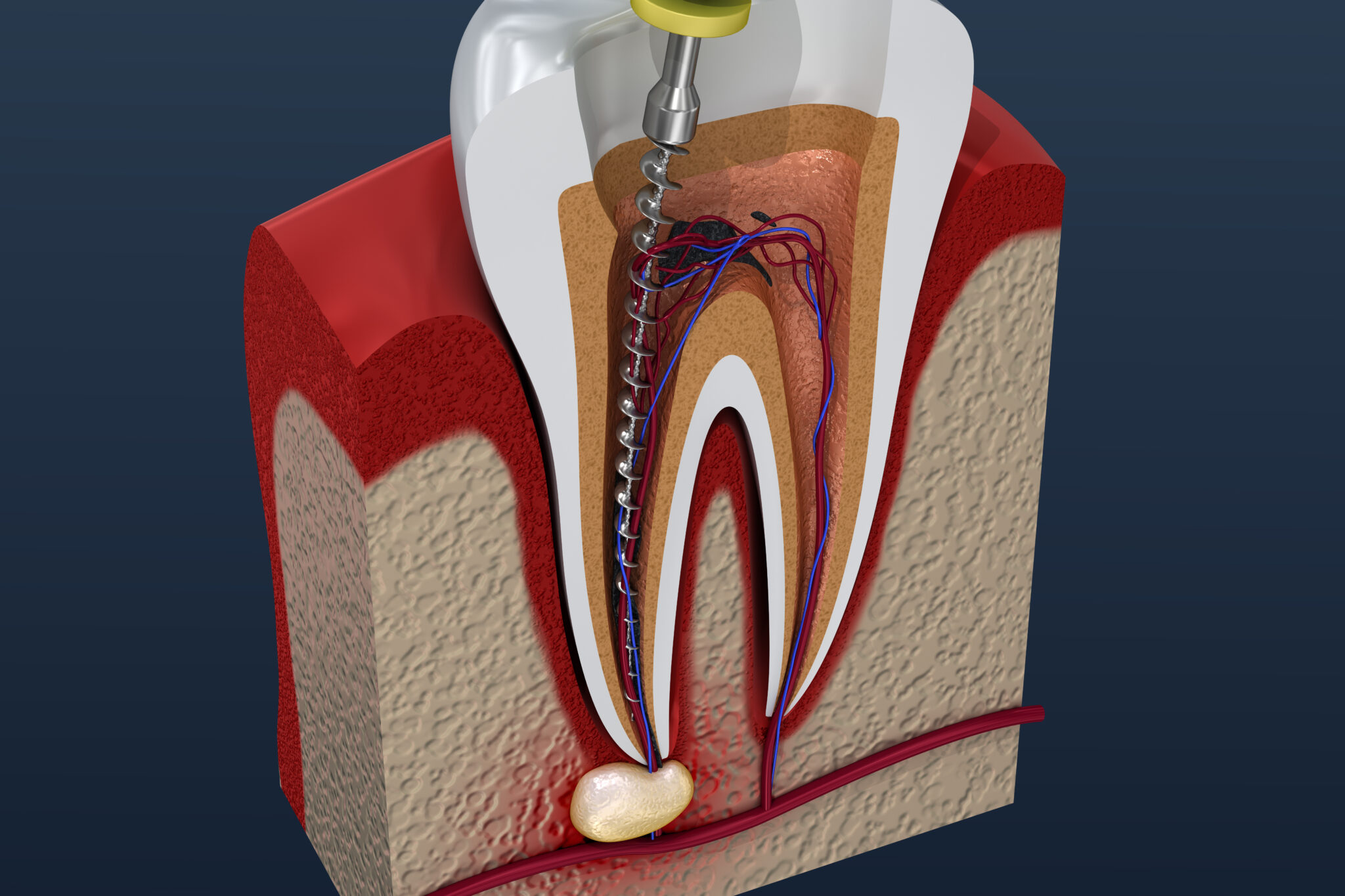 Endodontic Surgery Dentist in Salt Lake City, UT Platinum Dental