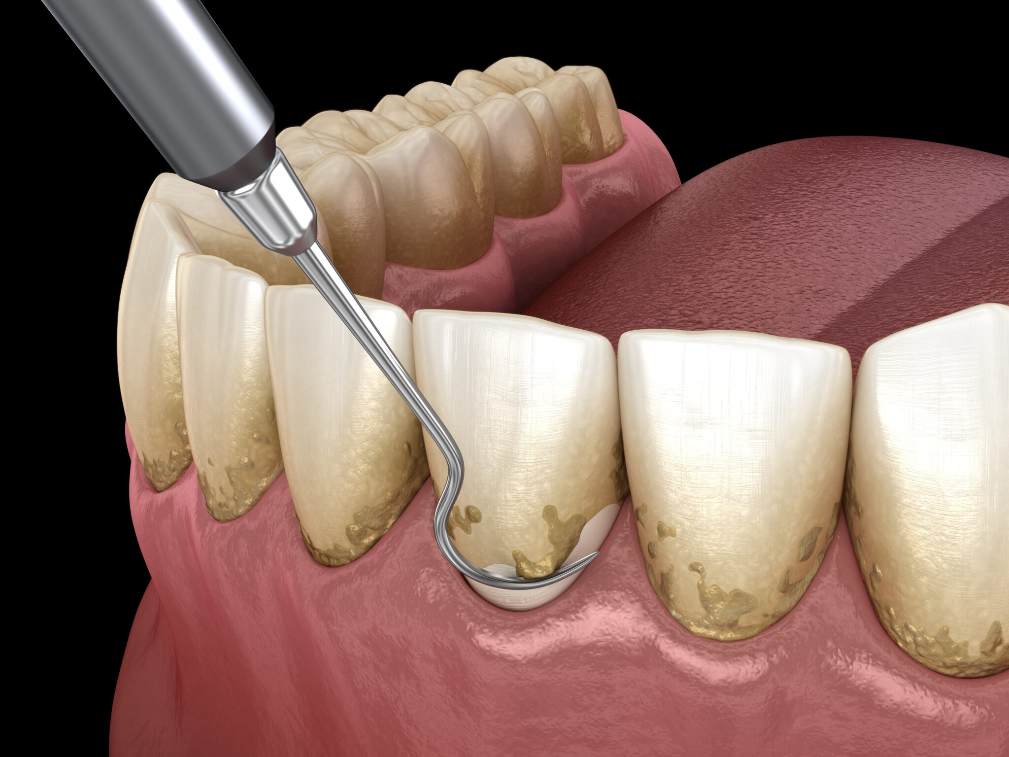 Scaling and Root Planing Dentist in Salt Lake City, UT Platinum Dental